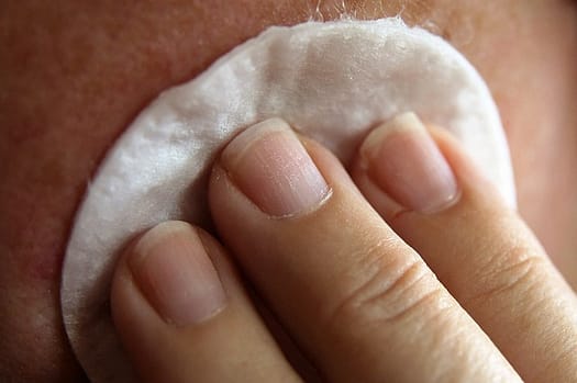 What You Need To Know about Natural Pimple Remedies (2)